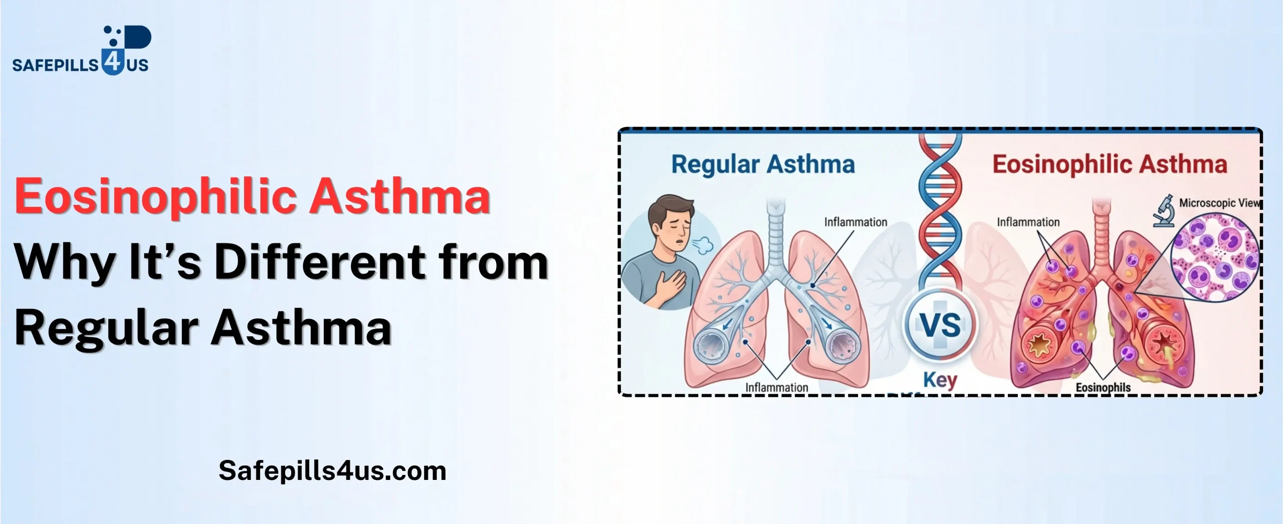 Eosinophilic Asthma: Why It’s Different from Regular Asthma